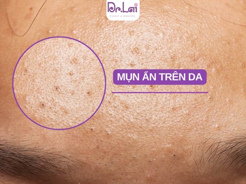 Ưu điểm của trị thâm mụn bằng phương pháp laser IPL
