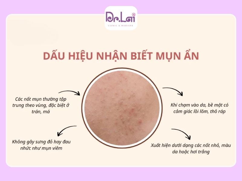 Trị Thâm Mụn Bằng Phương Pháp Laser IPL Có Hiệu Quả Không? Giải Pháp Làm Mờ Thâm Được Nhiều Người Quan Tâm