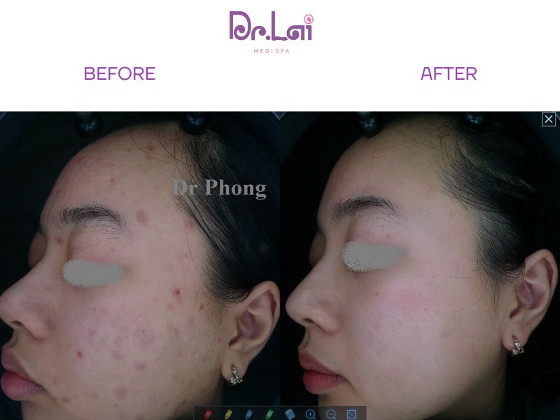 Laser YAG có giúp hết thâm hoàn toàn không?