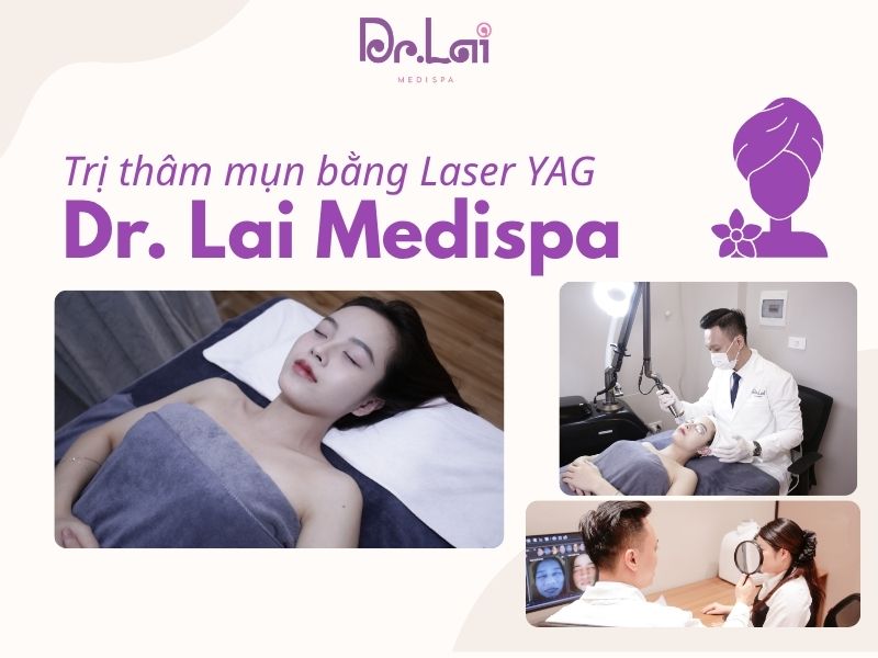 Ưu điểm của trị thâm mụn bằng phương pháp laser YAG