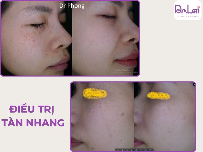 Dr.Lai – Giải pháp chăm sóc và điều trị nám tàn nhang an toàn